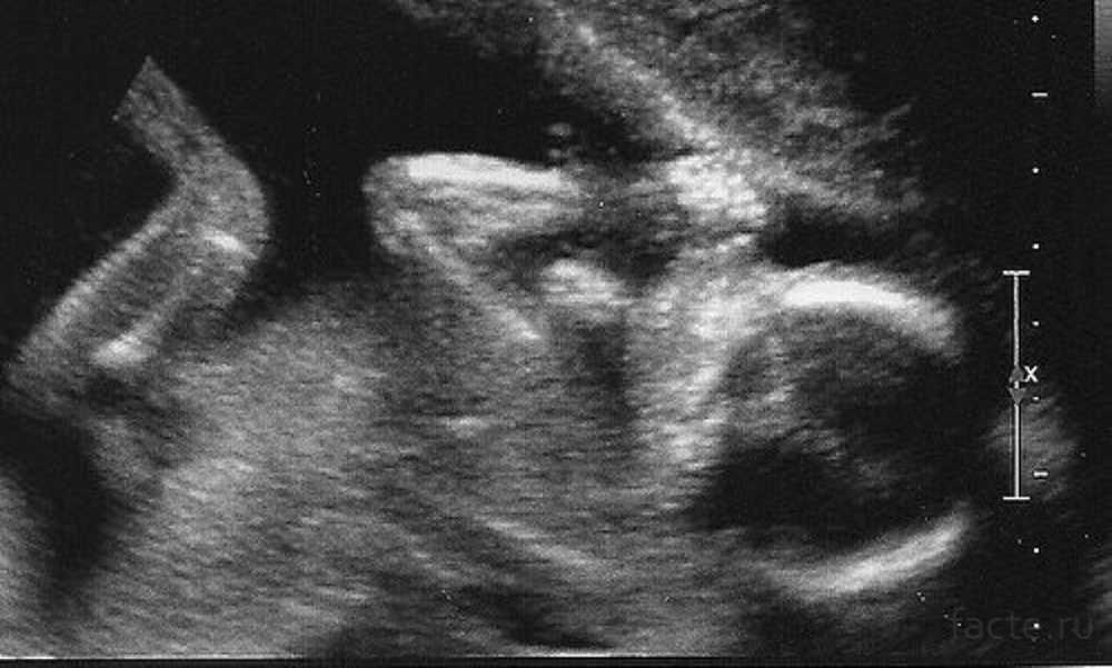 18 недель мальчик. 18 Недель беременности фото плода на УЗИ. 18 Недель беременности УЗИ плода. УЗИ 17-18 недель беременности. Фото УЗИ беременности 17-18 недель.