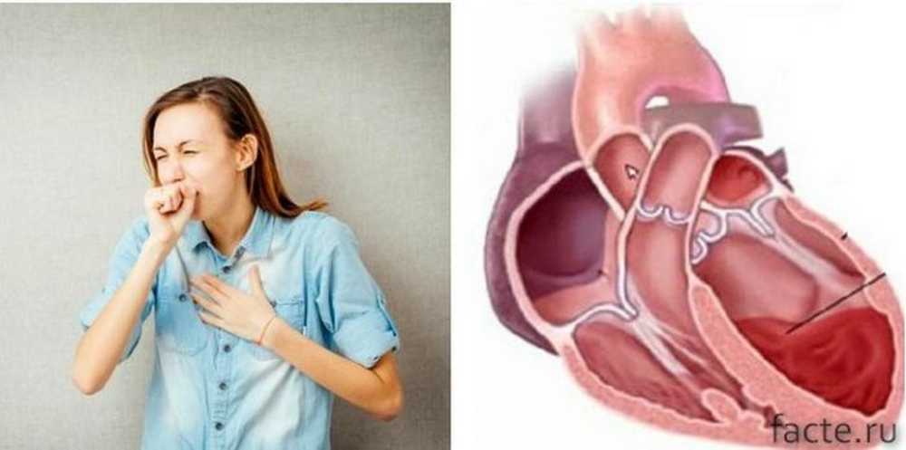 Сердечная мокрота. Одышка и кашель при сердечной недостаточности. Сердечная недостаточность кашель. Кровохарканье при сердечной недостаточности. Сердечная мокрота.