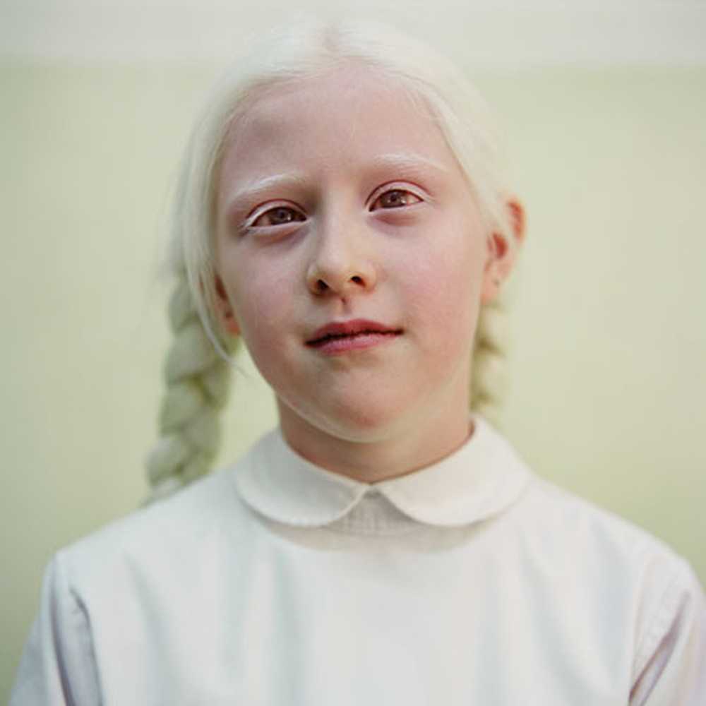 Альбинизмом страдают. Глазно-кожный альбинизм. Глазокожный альбинизм 1 а.